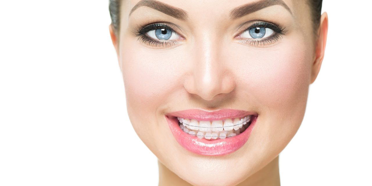 How to Whiten My Teeth with Braces: Achieving a Brighter Smile Safely