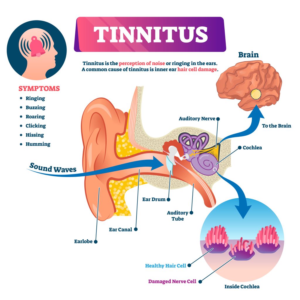Natural Cure for Tinnitus