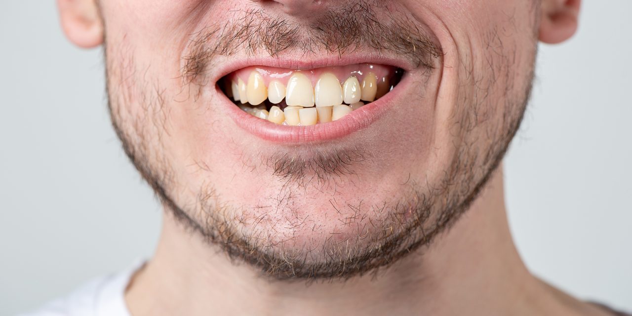 How to Whiten Teeth That Are Yellow: Your Guide to a Brighter Smile