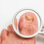 Can Toenail Fungus Cause Neuropathy: Understanding the Side Effects