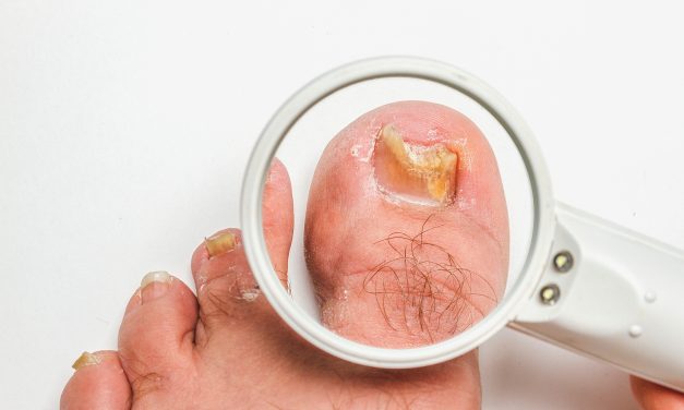 Can Toenail Fungus Cause Neuropathy: Understanding the Side Effects