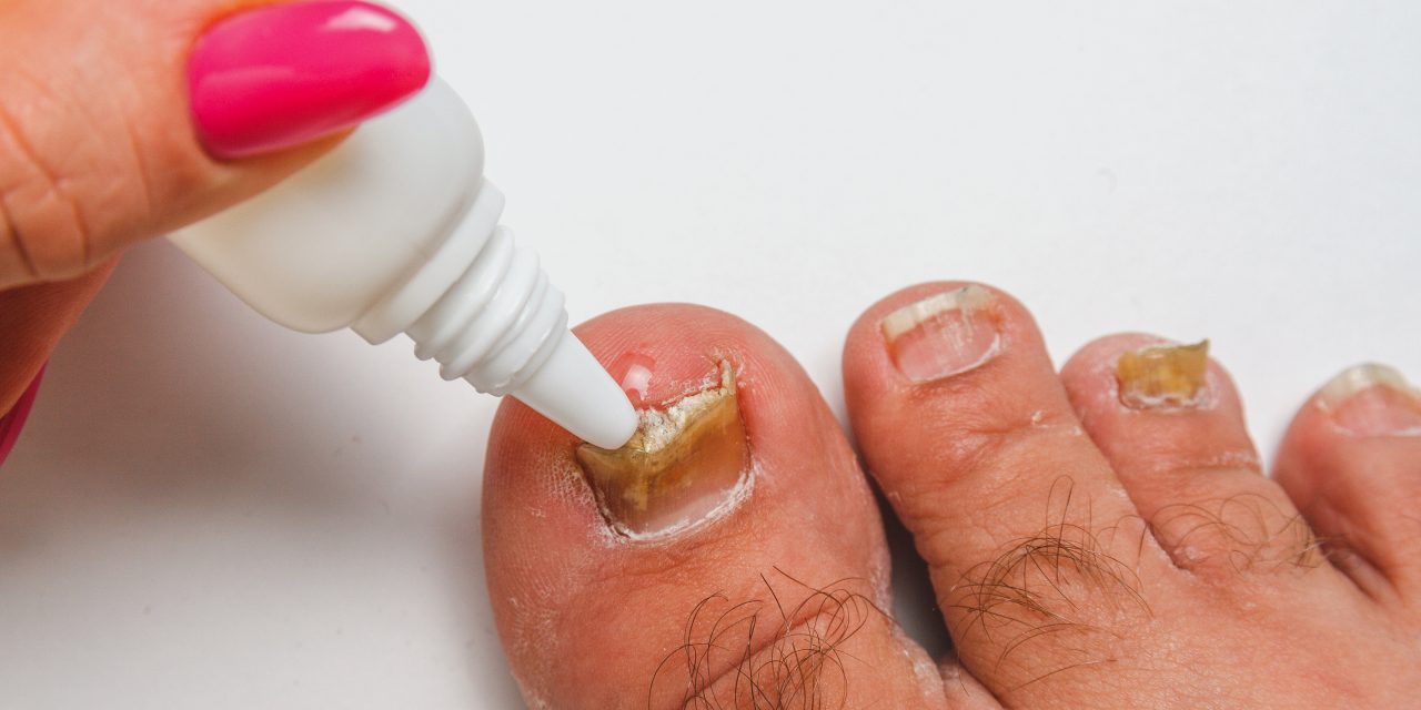 What Kills Toenail Fungus Instantly: Top Remedies and Solutions Revealed