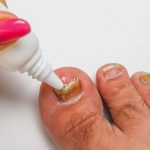 What Kills Toenail Fungus Instantly: Top Remedies and Solutions Revealed