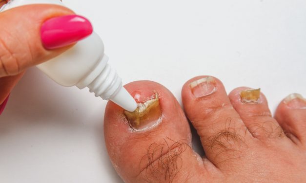 What Kills Toenail Fungus Instantly: Top Remedies and Solutions Revealed