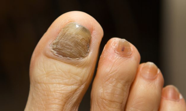 Can Toenail Fungus Cause Pain? Exploring the Connection and Symptoms