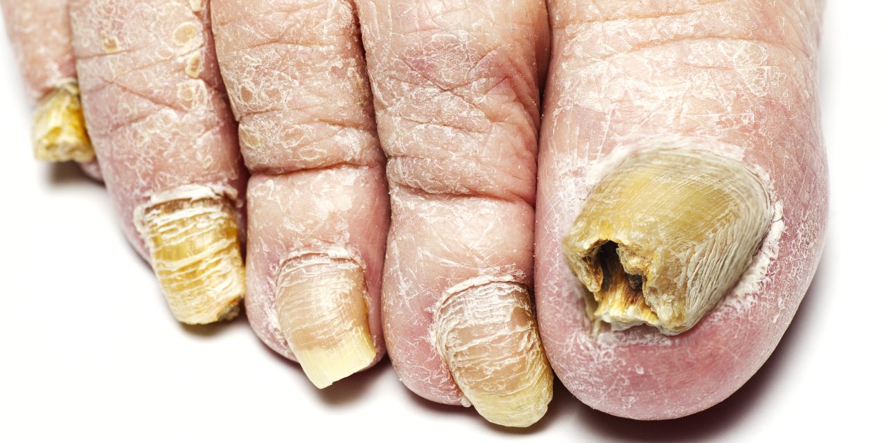 What Does Toenail Fungus Look Like: Identifying the Signs and Symptoms