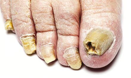 What Does Toenail Fungus Look Like: Identifying the Signs and Symptoms