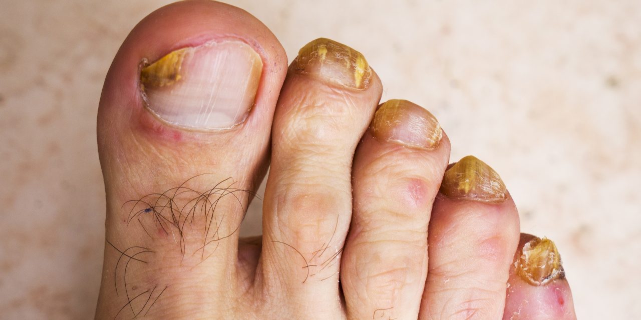 Where Does Toenail Fungus Come From: Causes and Sources Explained