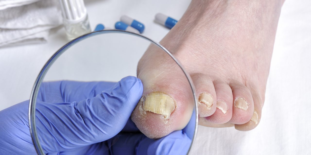 What Does Toenail Fungus Do to Your Feet: Understanding the Effects and Treatments