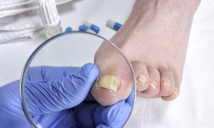What Does Toenail Fungus Do to Your Feet: Understanding the Effects and Treatments
