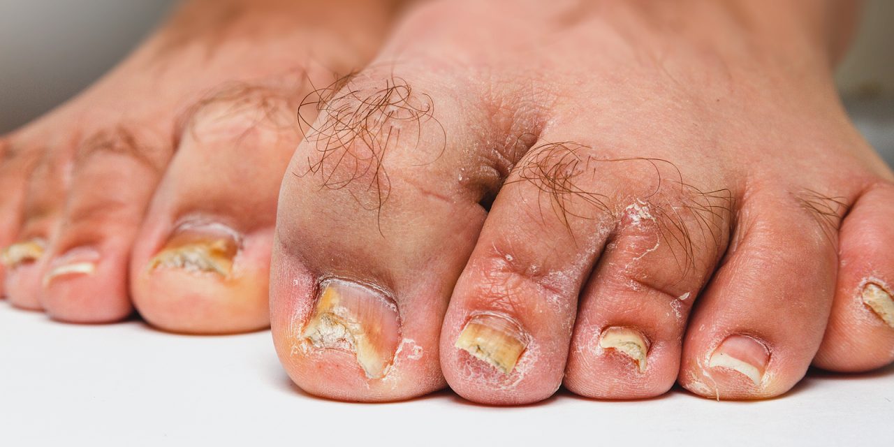 What is Toenail Fungus and How Do I Get Rid of It: Effective Treatment Strategies