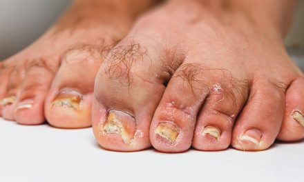 What is Toenail Fungus and How Do I Get Rid of It: Effective Treatment Strategies