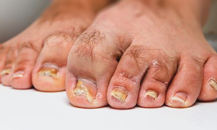 How Toe Fungus Starts: Causes and Prevention Tips