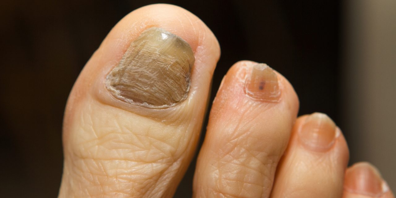 What Causes Toenail Fungal Infection: Key Factors Explained