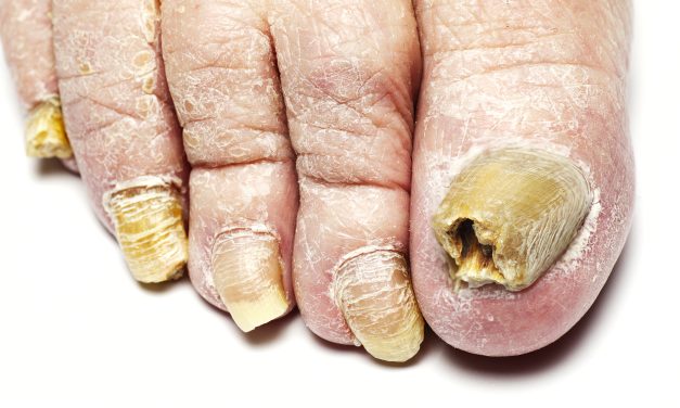 How Long Does Toe Fungal Infection Last: Duration and Treatment Insights