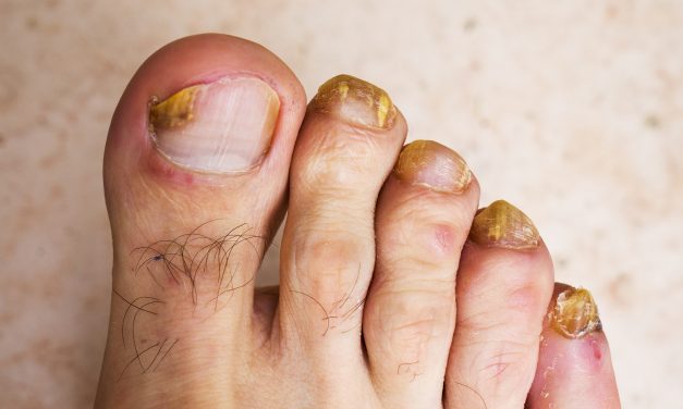 What Does Toe Fungal Infection Look Like: Key Symptoms and Signs