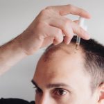 Can Hair Loss Be Reversed: Understanding Treatment Options