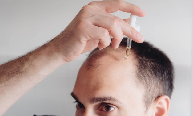 Can Hair Loss Be Reversed: Understanding Treatment Options