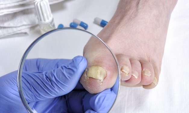 How to Treat Toe Fungal Infection: Effective Remedies Explained