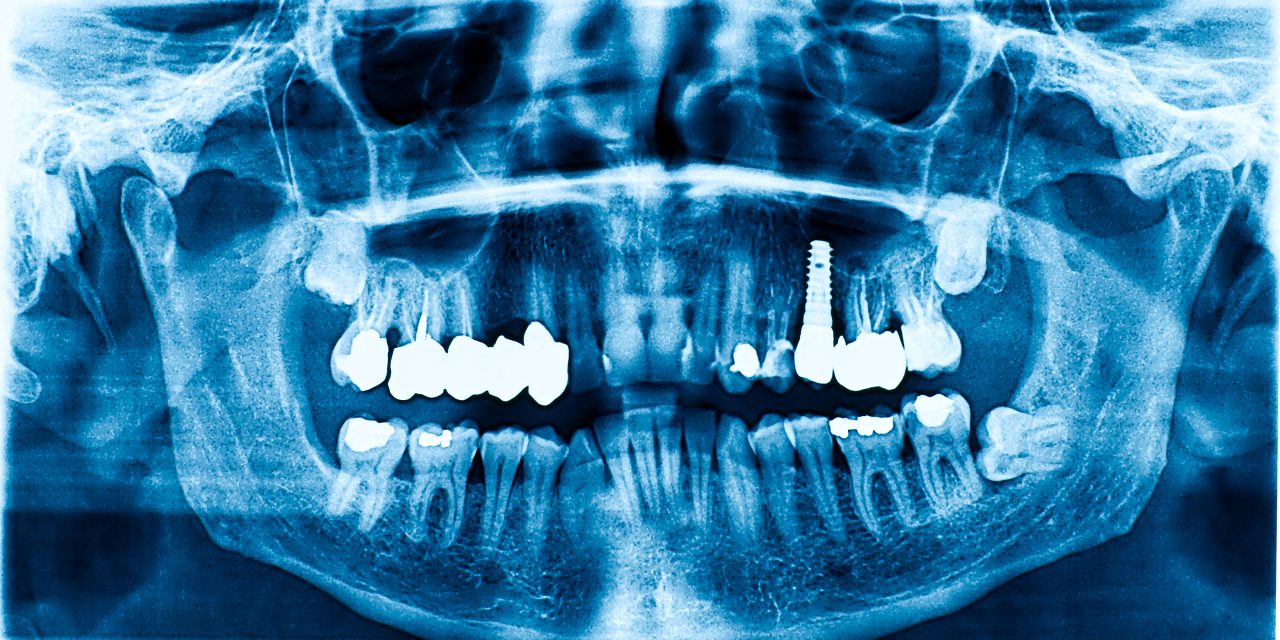 Are Dental X Rays Safe: Understanding the Risks and Benefits