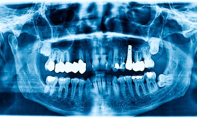 Are Dental X Rays Safe: Understanding the Risks and Benefits