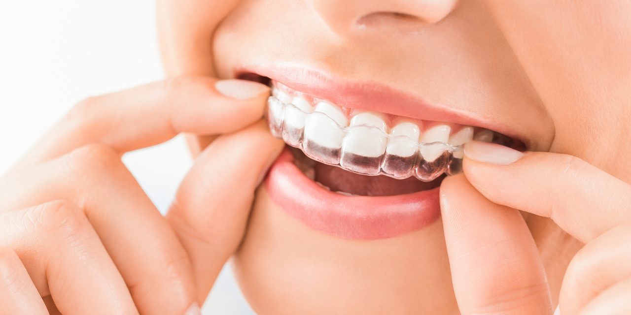 How Dental Braces Work: Understanding Their Function and Benefits