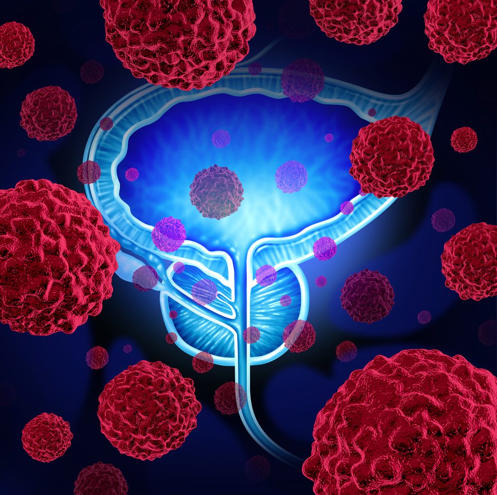Prostate Enlargement